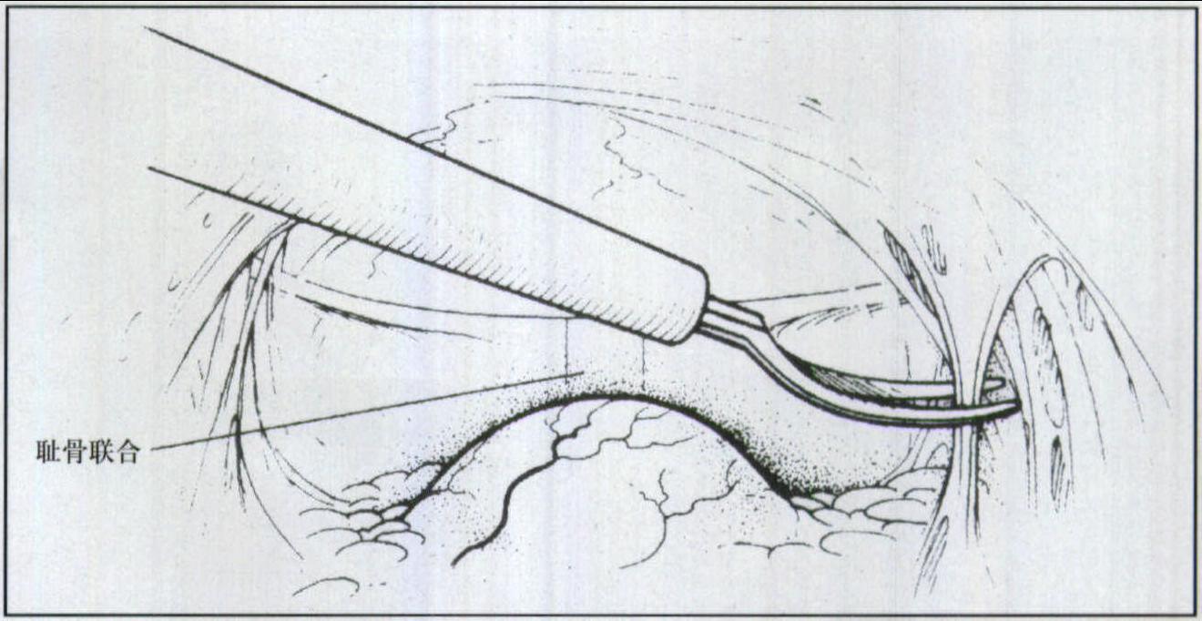 十四、腹腔鏡膀胱頸懸吊術(shù)